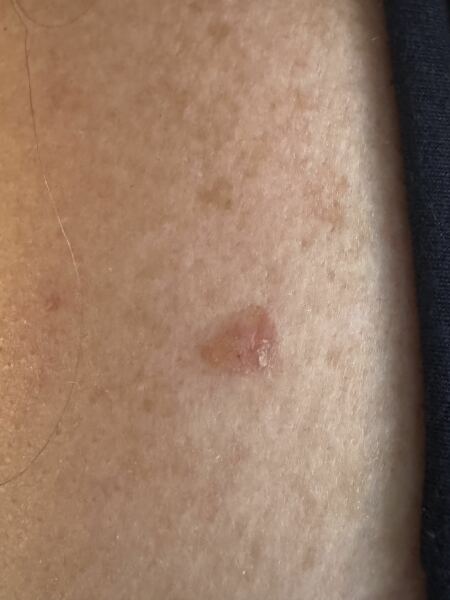 Would you worry about this? How badly would u need to see the doctor? Picture included.