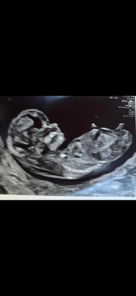 Boy or girl 12 weeks scan