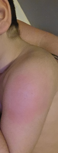 Post Vaccination redness?