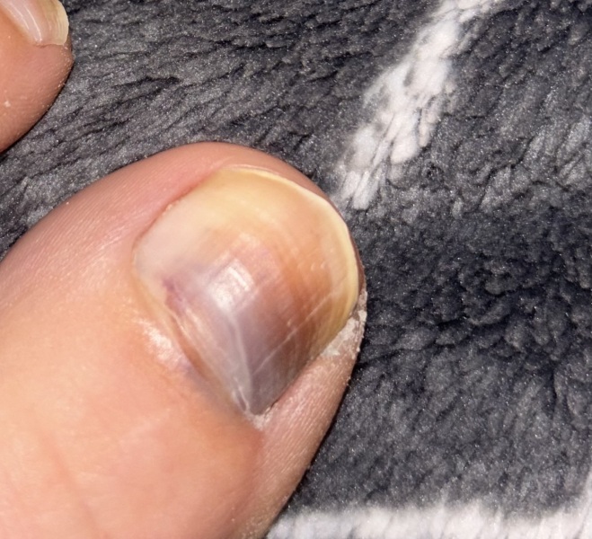 Any dermatologist or podiatrist around?(pic of a toenail in post)