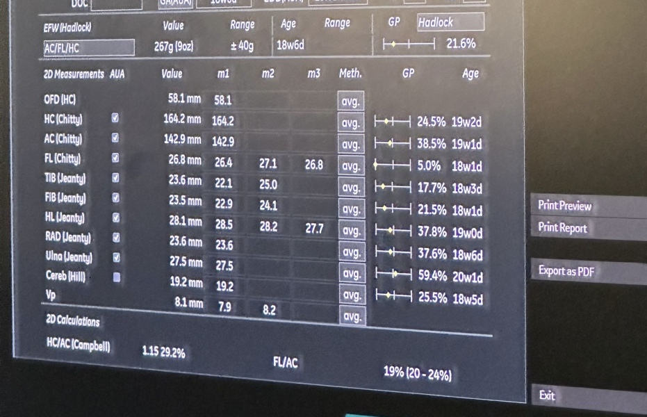 Terrified 20 week scan and short femurs
