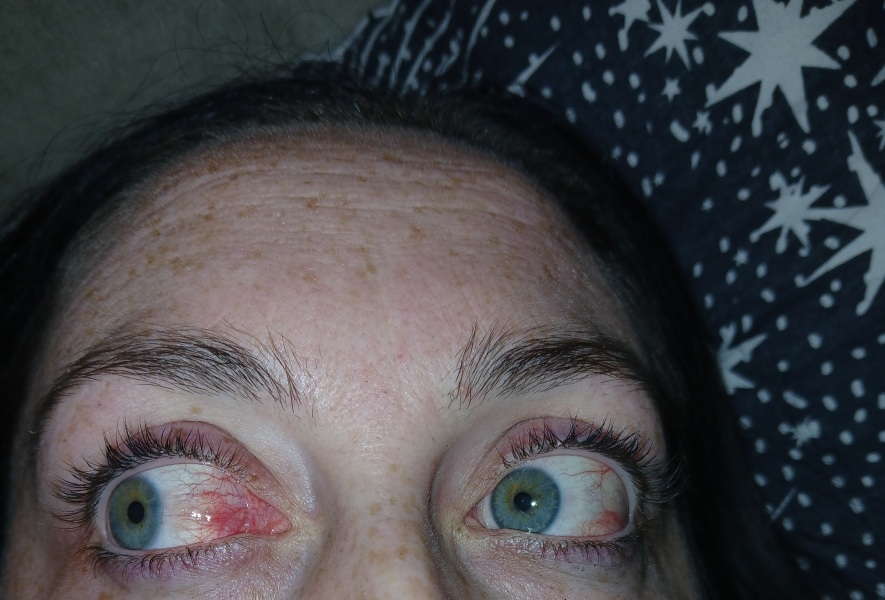 Sore eyes