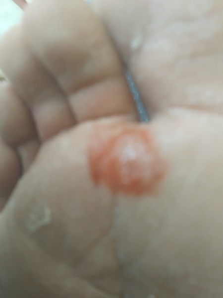 Shamelessly posting for traffic. Medical question and im definitely AIBU for posting disgusting pictures looking for answers