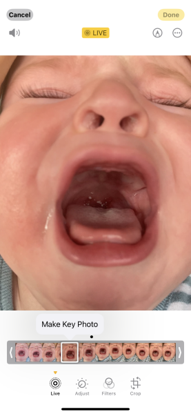 White spots on breastfed baby throat - Milk curds?
