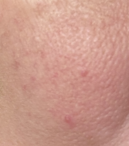 Bumps/spots on one cheek