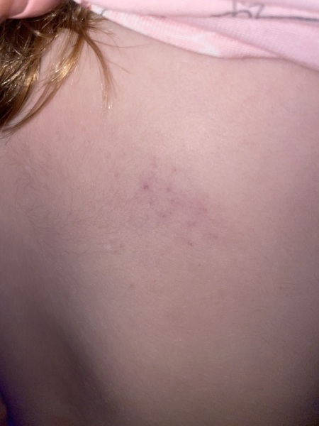 Small patch of what I think is petechiae on DD back. I am spiralling with healt anxiety