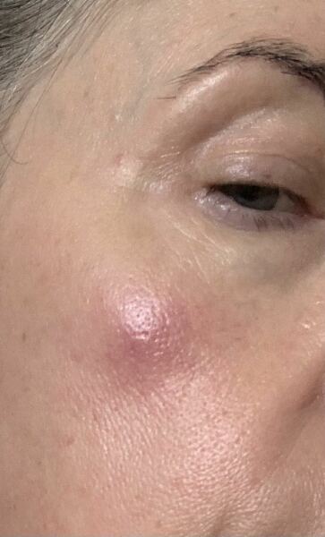 Wanna see my face lump?