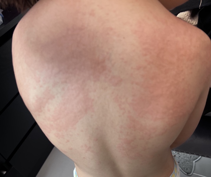Child’s sudden allergy?