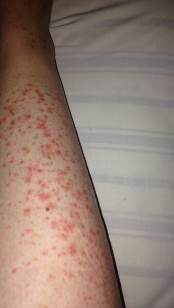 What is this rash?