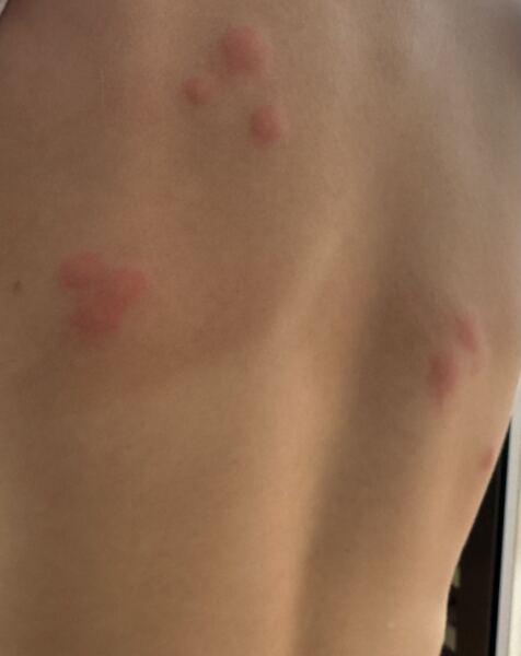 What bites are these?