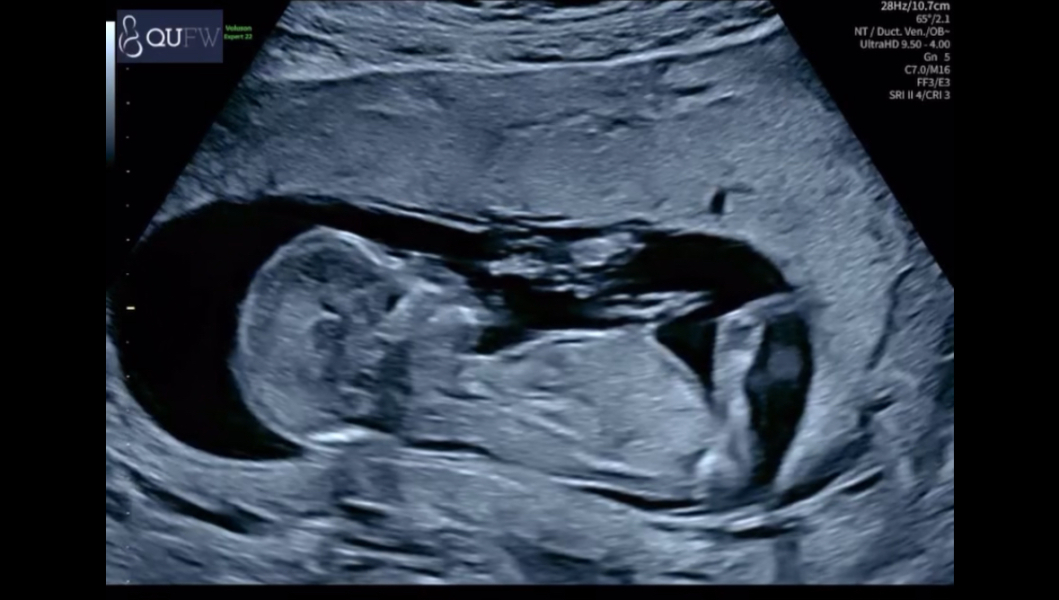Boy or girl