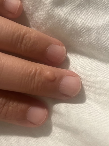 Lump on finger