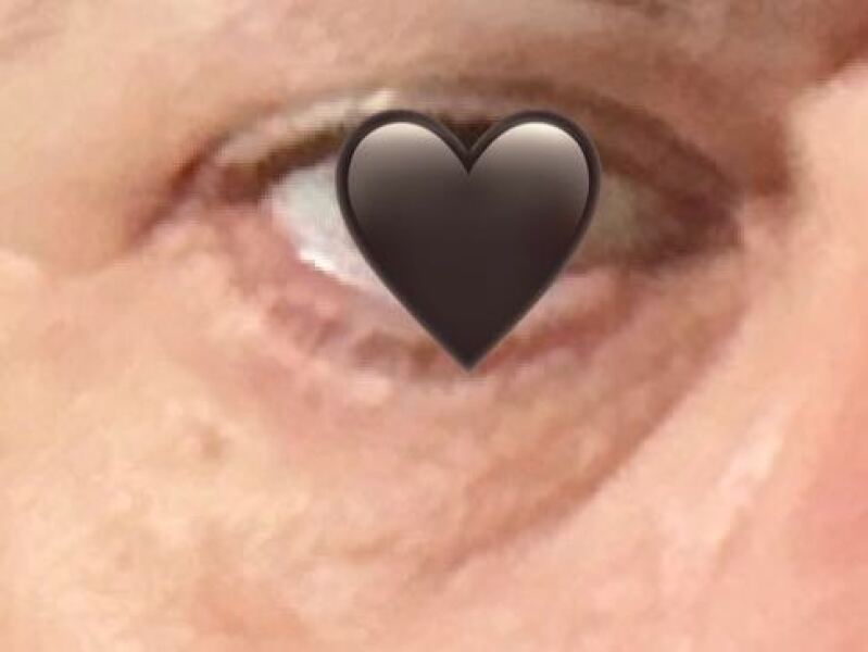 Under eye bags - help me get rid of them