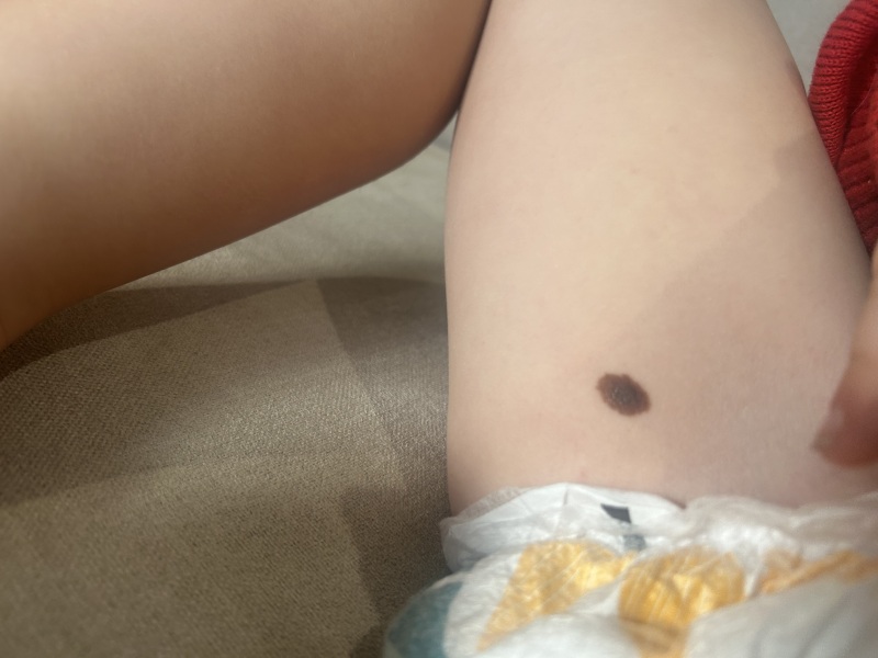 Mole on child