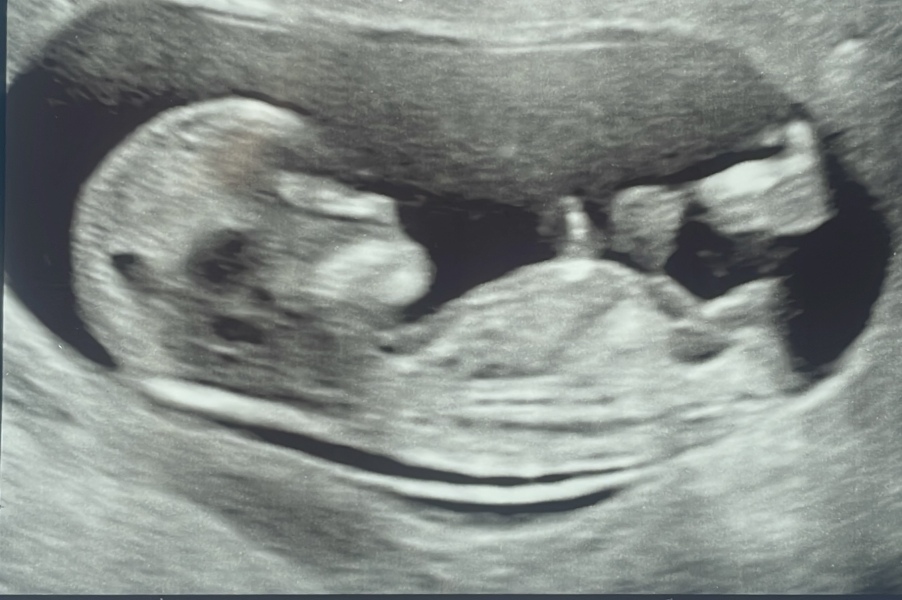 Gender guesses? 12 week scan!