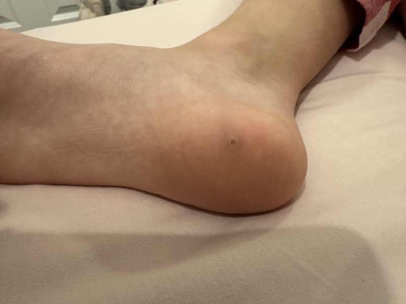 To wonder if this is an infection tracking up my child’s foot?