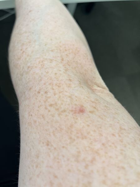 Is this a skin tag?
