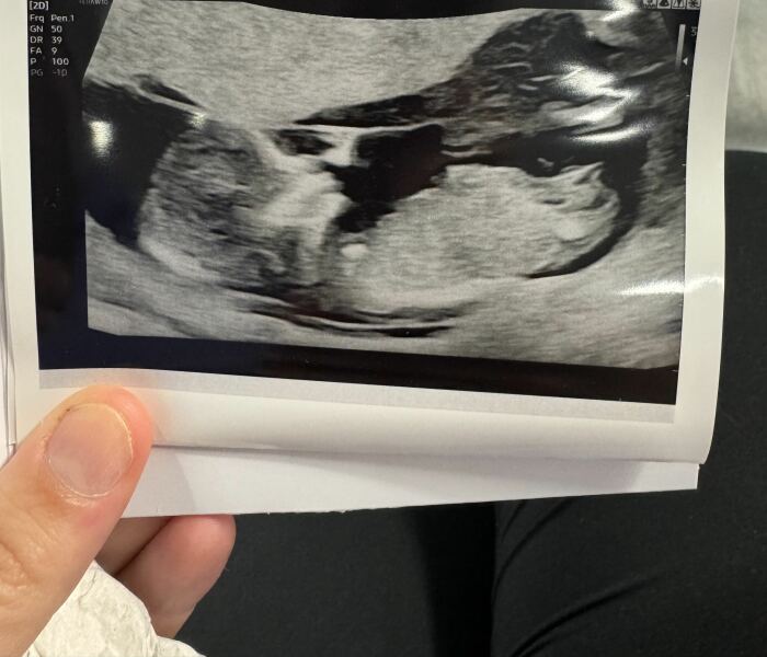 Boy or Girl?? Nub theory guesses