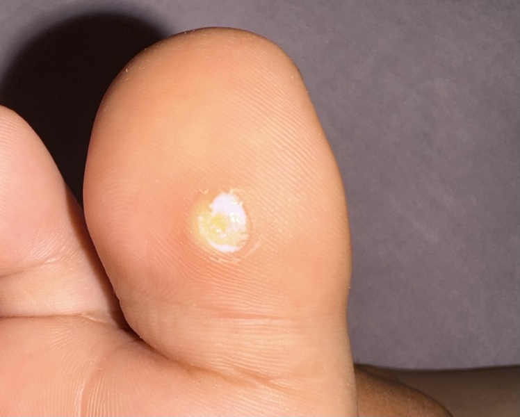 What is this on my child’s toe?