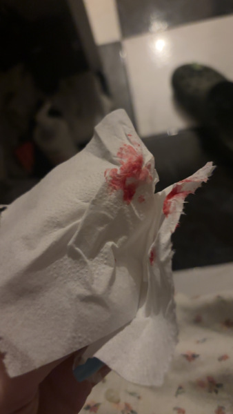8 weeks pregnant with twins and bleeding TW: INCLUDES PHOTO