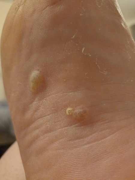 Shamelessly posting for traffic. Medical question and im definitely AIBU for posting disgusting pictures looking for answers