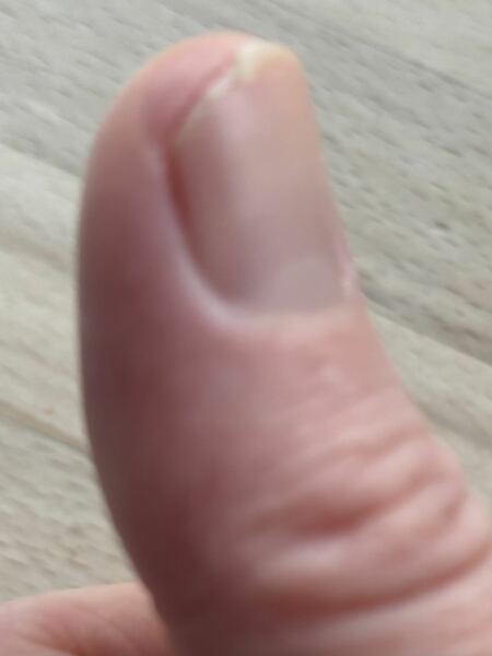 Is my finger infected?