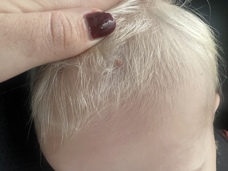 Skin tag? Worried mummy