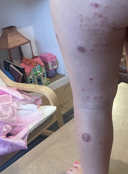 Molluscum contagiosum