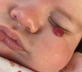 Haemangioma/propranolol