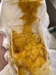 CMPA Baby Poop?