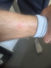 Is this a bite?