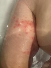 What do you think this rash is?