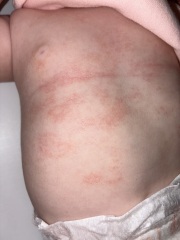 Simply dry skin, or a rash?