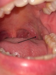 Long-term very small, painless growth or lump inside mouth/throat