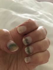Badly damaged nails (photos)- please help!