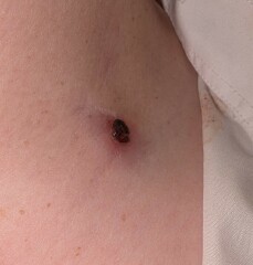 DS13 'cyst' making a bid for freedom??