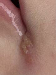 Cold sore, angular cheilitis or other?