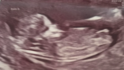 12+4 with twins - nub theory, just for fun!