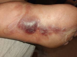 Shamelessly posting for traffic. Medical question and im definitely AIBU for posting disgusting pictures looking for answers