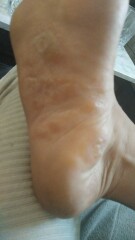 Shamelessly posting for traffic. Medical question and im definitely AIBU for posting disgusting pictures looking for answers