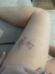 Massive bruise after scratching
