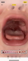 White spots on breastfed baby throat - Milk curds?