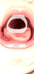 White spots on breastfed baby throat - Milk curds?