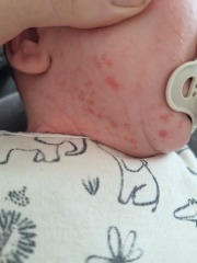 Is this baby acne??