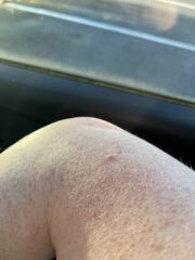 Is this a skin tag?