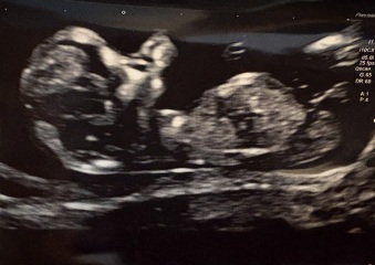 Girl or boy nub?? Gender prediction/guesses