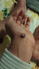 Shamelessly posting for traffic. Medical question and im definitely AIBU for posting disgusting pictures looking for answers