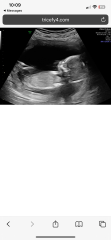 Does my baby’s face on ultrasound look normal?