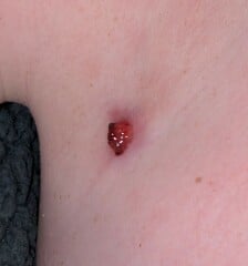 DS13 'cyst' making a bid for freedom??