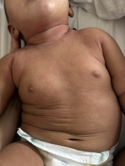 Help??? Aptamil pepti 1 made baby worse